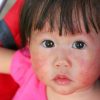Dealing with Baby Allergies