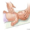 Watch Out! Treating a Choking Baby